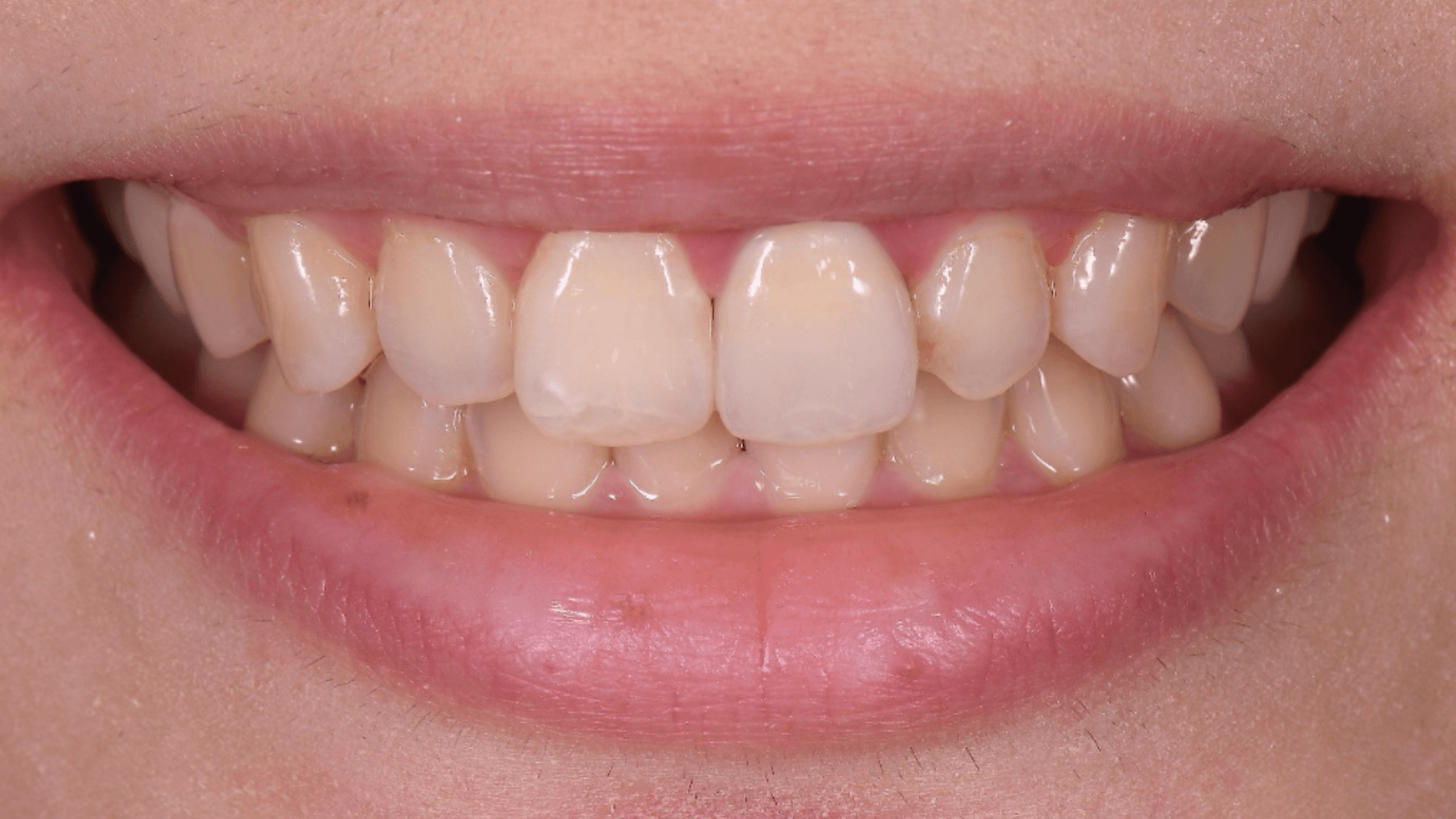 Voor-en-na resultaat van volledige gebitsrehabilitatie na behandeling – Smile Boutique Hasselt