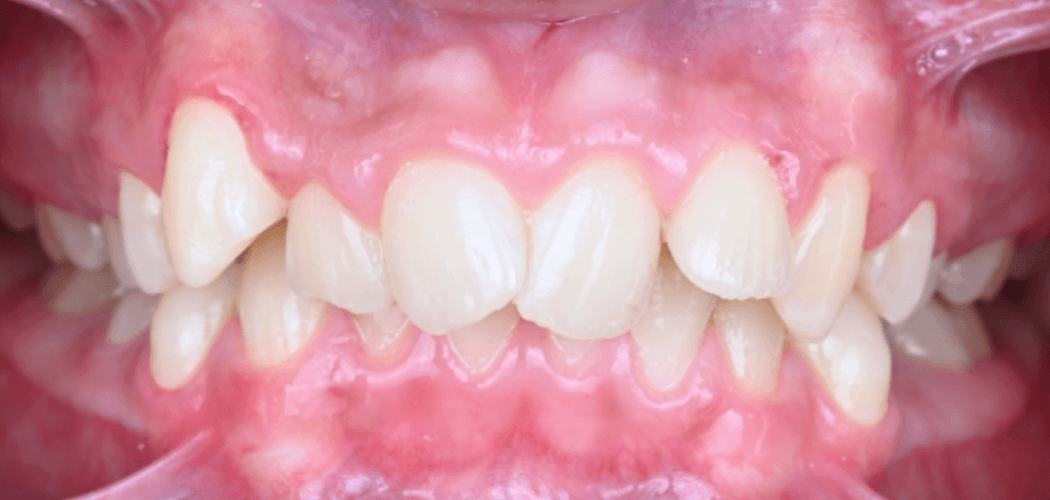 Invisalign voor-en-na resultaat bij crowding vóór behandeling – Smile Boutique Hasselt