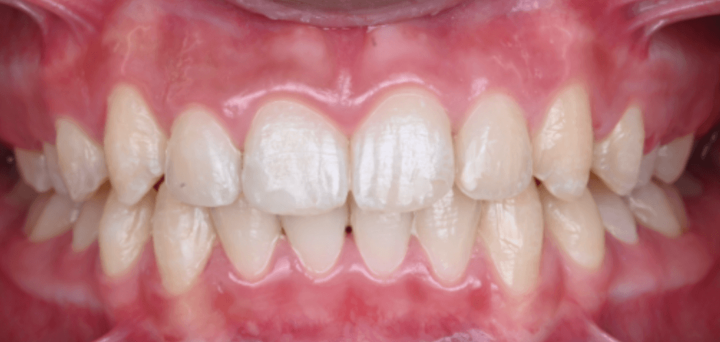 Invisalign voor-en-na resultaat bij crowding na 14 maanden behandeling – Smile Boutique Hasselt
