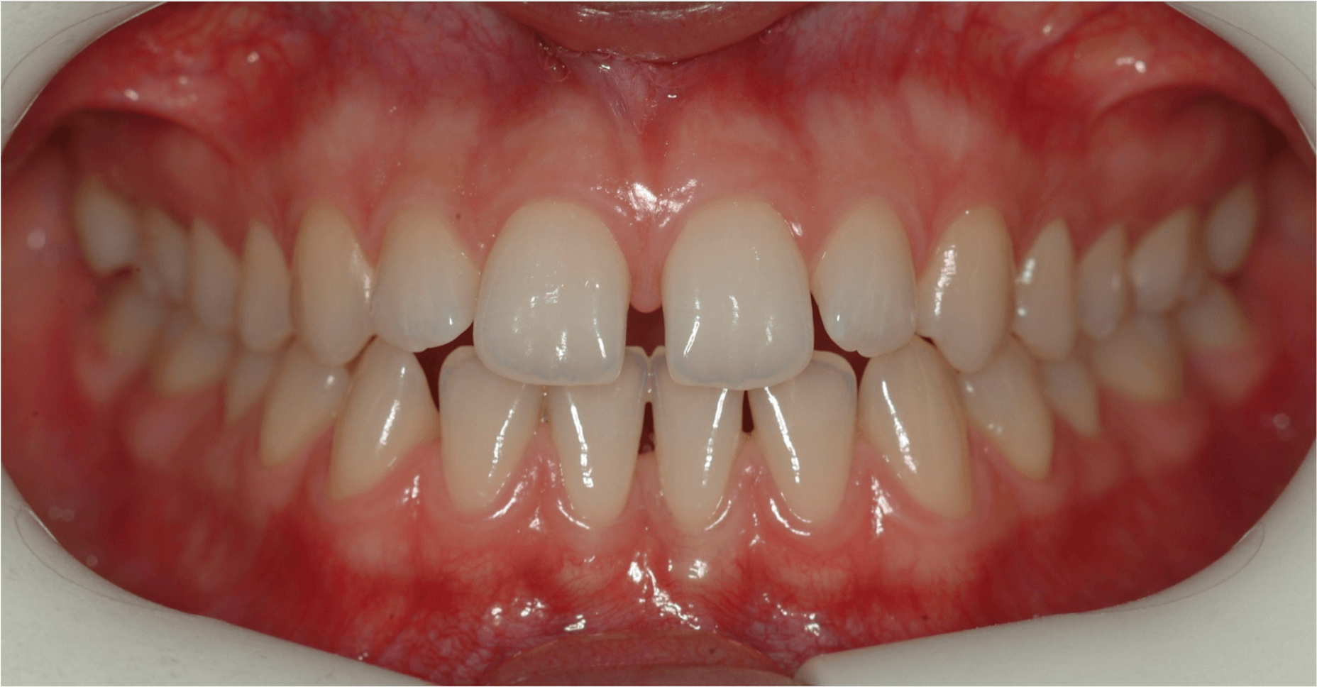 Invisalign voor-en-na resultaat bij diasteemsluiting vóór behandeling – Smile Boutique Hasselt