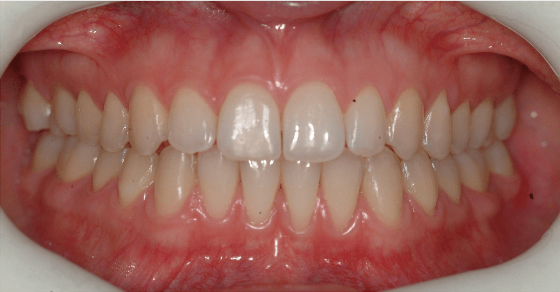 Invisalign voor-en-na resultaat bij diasteemsluiting na behandeling – Smile Boutique Hasselt