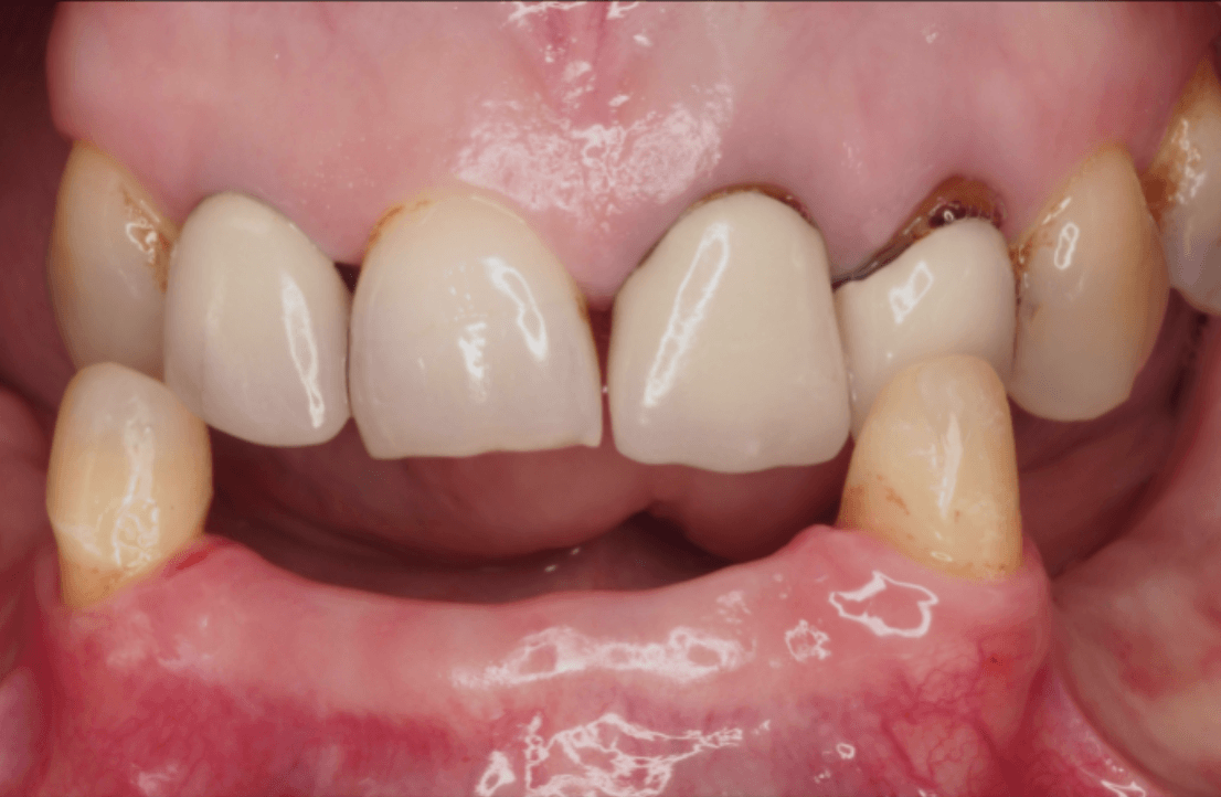 Implantaten voor-en-na – Smile Boutique Hasselt