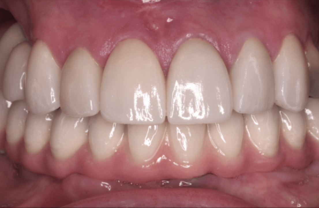Invisalign voor-en-na resultaat bij crowding na 14 maanden behandeling – Smile Boutique Hasselt