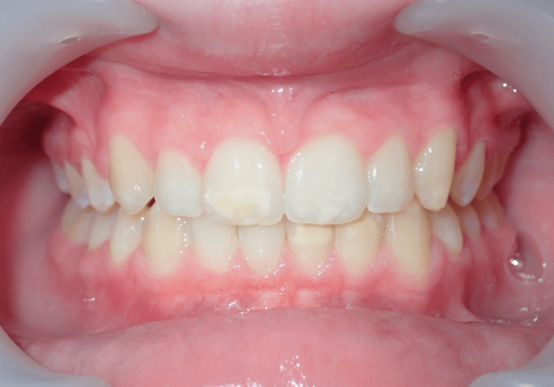 Invisalign voor-en-na resultaat bij tiener – Smile Boutique Hasselt