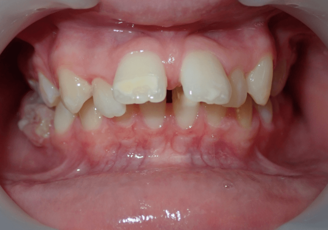 Invisalign tiener voor-en-na – Smile Boutique Hasselt